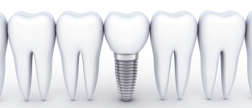 dental-implants-in-sydney
