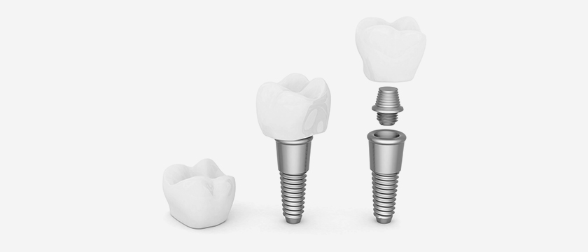 dental implant cost thailand