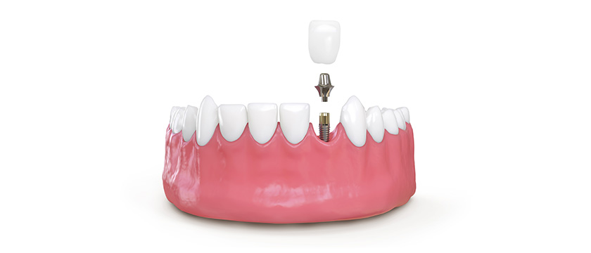 dental-implants-sydney-cbd