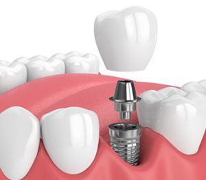 dental-implant-overseas-sydney