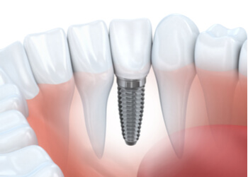 dental bridge vs implant sydney