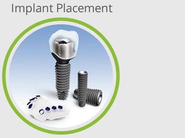 implant-placement