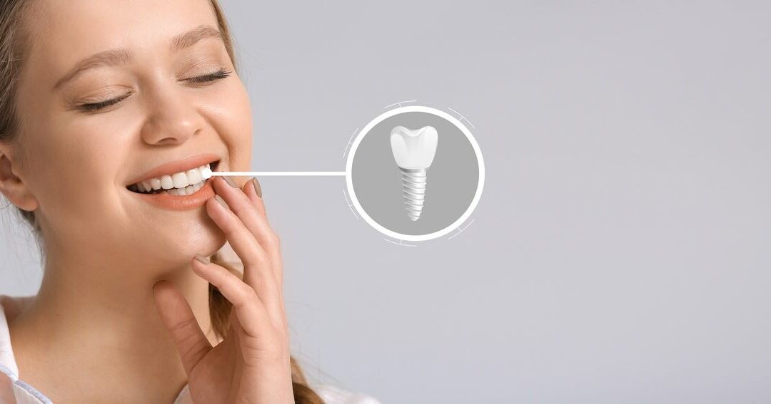 Understanding the Problems with All-On-4 Dental Implants And How to Fix Them