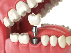 dental-implant-procedure-sydney