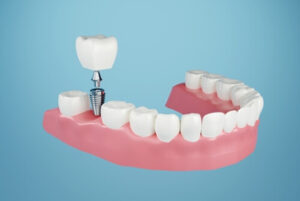 Affordable Dental Implants illustration