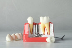 Affordable Dental Implants image
