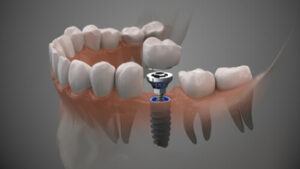 Affordable Dental Implants single
