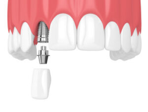 Dental Implants Philippines illustration sydney