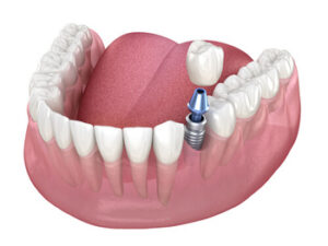Dental Implants Turkey procedure sydney