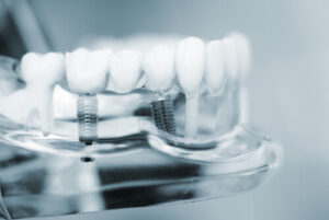 Cost Of Single Tooth Implants illustration sydney