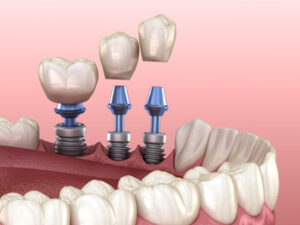 Cost Of Single Tooth Implants placement sydney