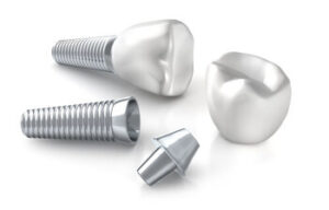 Dental Implant cost bali parts sydney