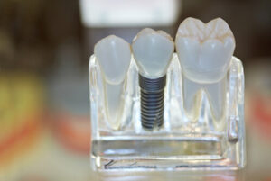 Dental Implant Kuala Lumpur illustration sydney