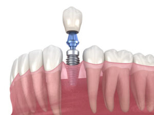 Dental Implants Manila placement sydney