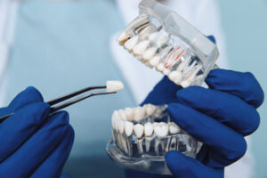 tooth implant expenses bangkok sydney