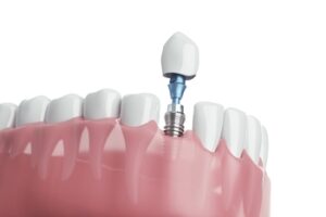 average fees of dental implant sydney gosford