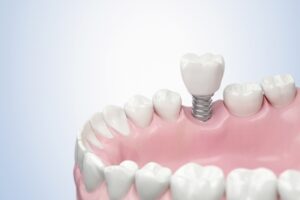 average rate of dental implant sydney gosford 