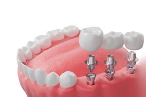 costing avegarge of dental implant sydney gosford