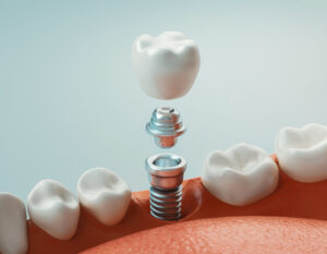 expenses average of dental implant sydney gosford