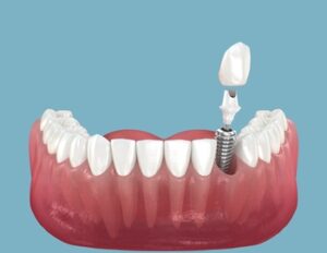 price average of dental implant sydney gosford
