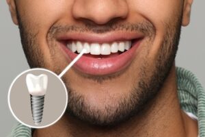 charges for dental implant crown sydney gosford