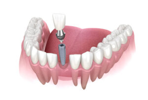 costs of dental implant overseas sydney gosford