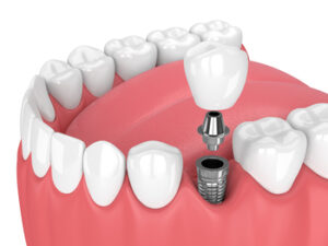 expenses of bone augmentation for tooth implants in australia sydney gosford