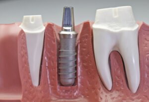 fees of dental implant crown sydney gosford
